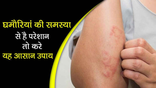 अगर आप घमौरिया की समस्या(prickly heat) से परेशान हैं, तो यह 5 सरल उपाय