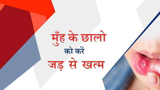 मुँह के छालों (Mouth ulcers)को करें जड़ से खत्म