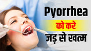 Pyorrhea