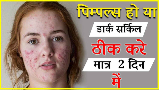 कील-मुहासे(Acne pimples)को हटाने के सबसे आसान घरेलु उपचार