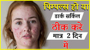 कील-मुहासे(Acne pimples)को हटाने के सबसे आसान घरेलु उपचार