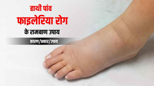 हाथी पांव (Filarial disease) को ठीक करने के 4 बेहतरीन उपाय